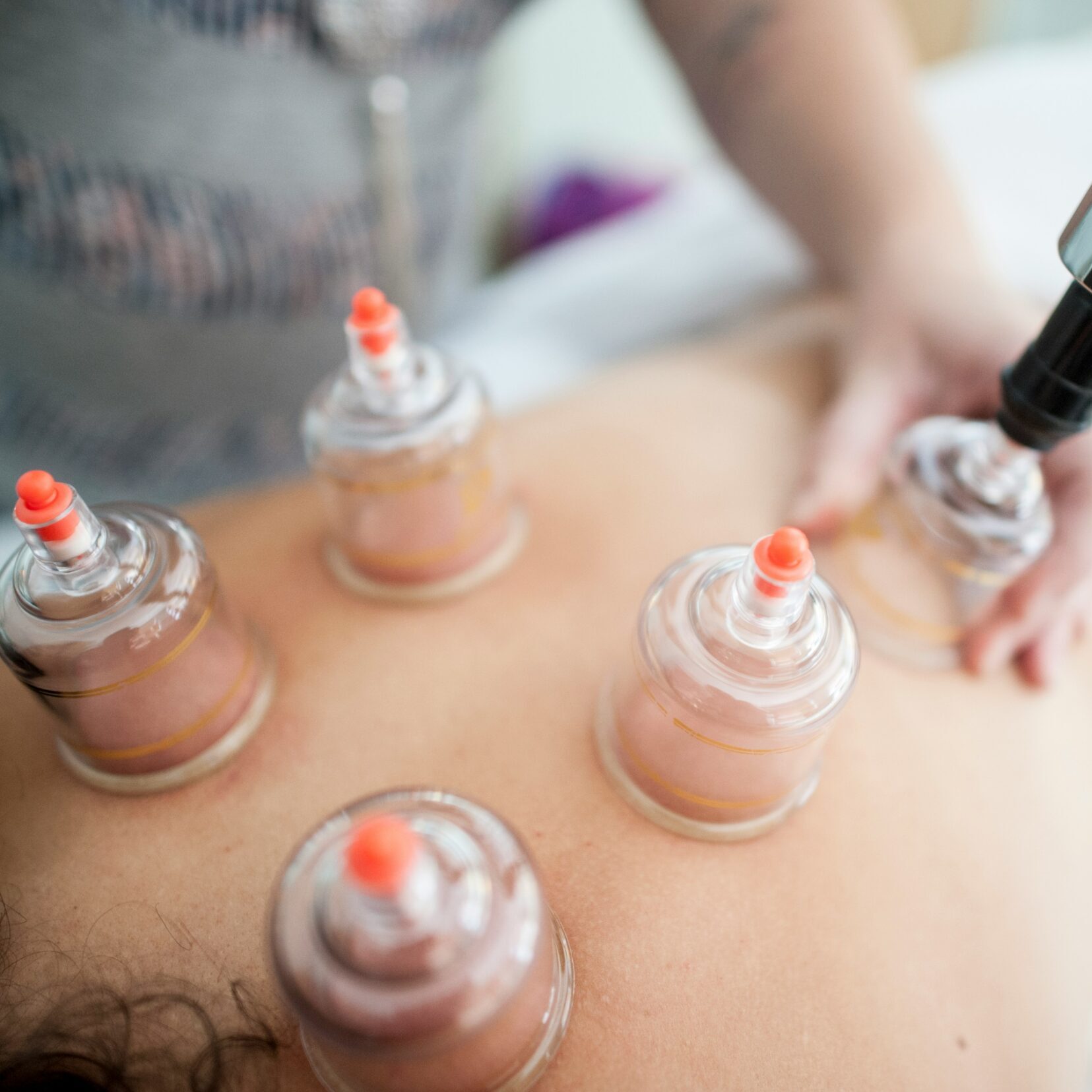 Cupping, acupuncture